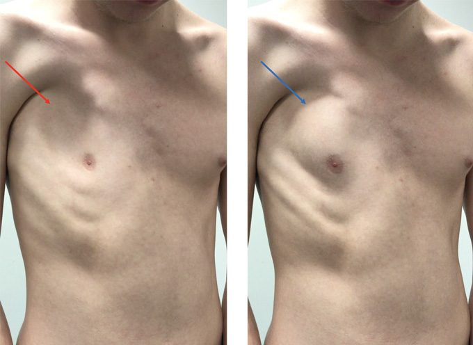 Bump on Chest, Different Types of Chest Lumps & Causes