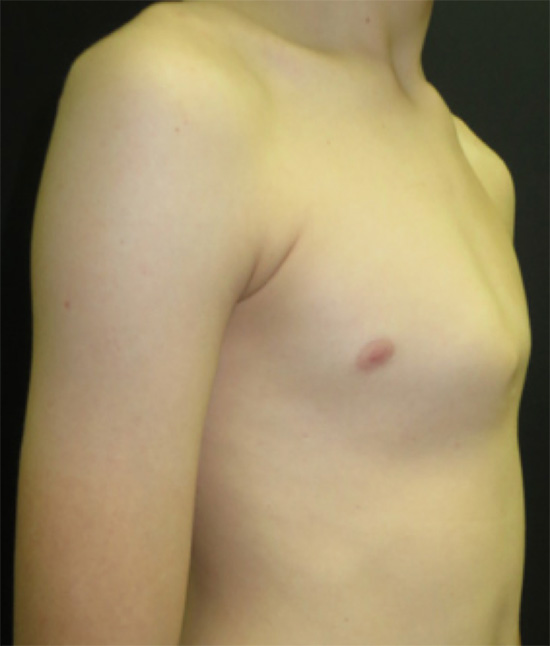 painful lump in breast male