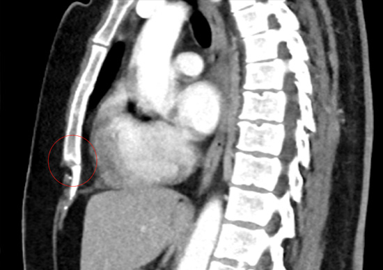 Chronic xiphersternal junction fracture