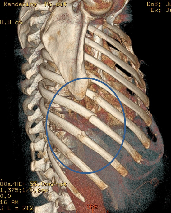 FlexaMed Men's 6 Wide Rib Belt  Injured rib cage, broken rib pain