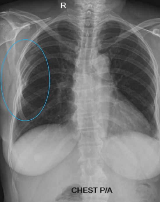 signs of rib trauma in a toddler