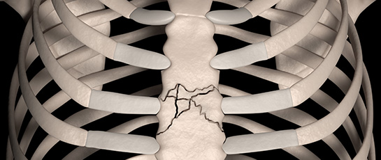 Sternal injuries